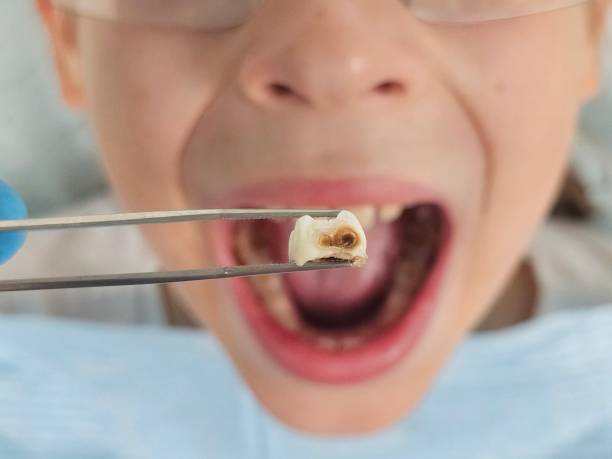 Best Cracked Tooth Emergency Dentist  in Colfax, CA